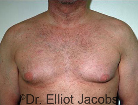 Male breast, before Gynecomastia treatment, front view, patient 49