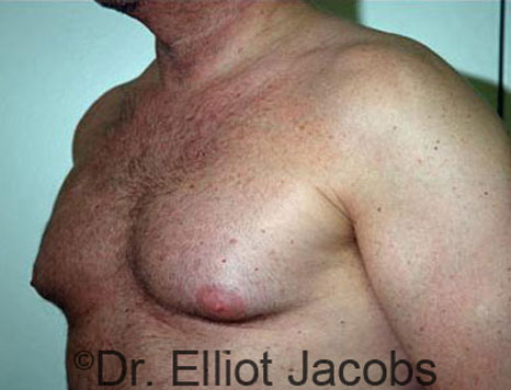 Male breast, before Gynecomastia treatment, l-side oblique view - patient 49