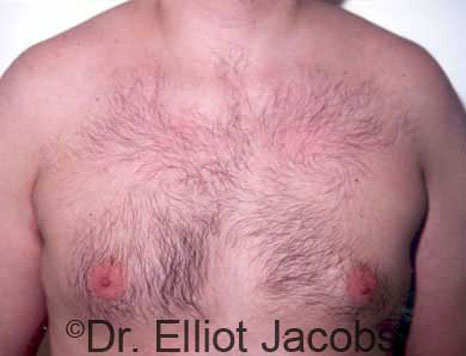 Male breast, before Gynecomastia treatment, front view, patient 5