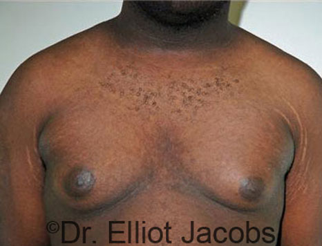 Male breast, before Gynecomastia treatment, front view, patient 50