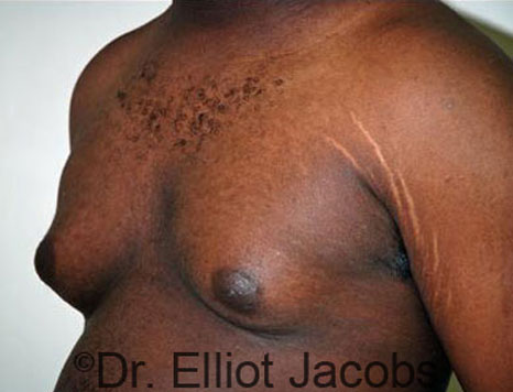 Male breast, before Gynecomastia treatment, l-side oblique view - patient 50