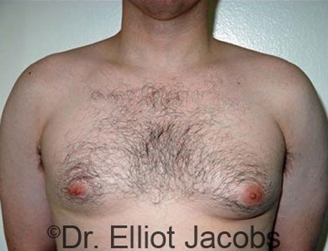 Male breast, before Gynecomastia treatment, front view, patient 51