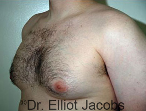 Male breast, before Gynecomastia treatment, l-side oblique view - patient 51