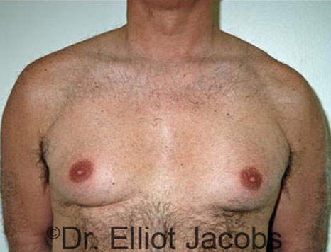 Male breast, before Gynecomastia treatment, front view, patient 52