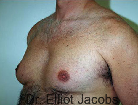 Male breast, before Gynecomastia treatment, l-side oblique view - patient 52