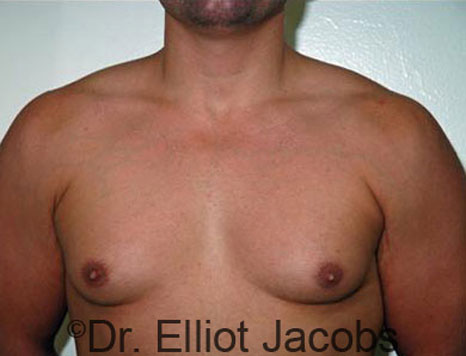 Male breast, before Gynecomastia treatment, front view, patient 53
