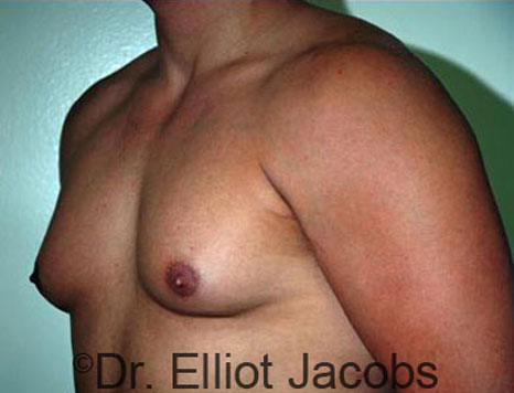 Male breast, before Gynecomastia treatment, l-side oblique view - patient 53