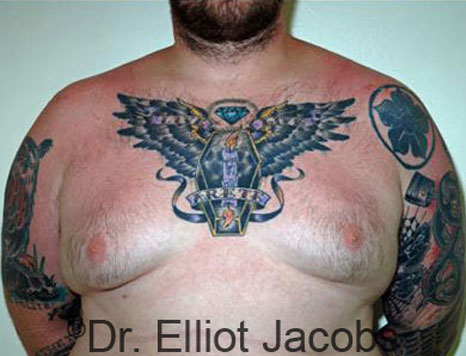 Male breast, before Gynecomastia treatment, front view, patient 54
