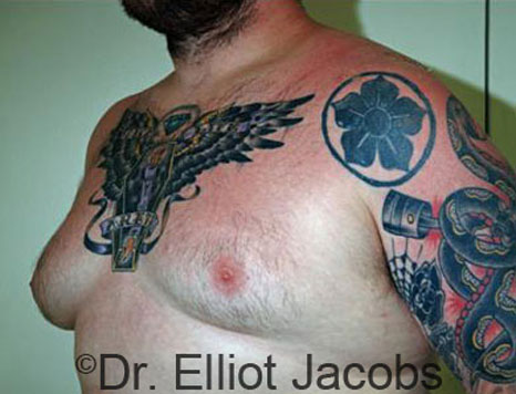 Male breast, before Gynecomastia treatment, l-side oblique view - patient 54