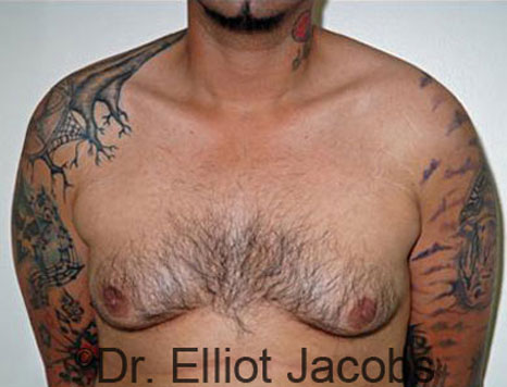 Male breast, before Gynecomastia treatment, front view, patient 55