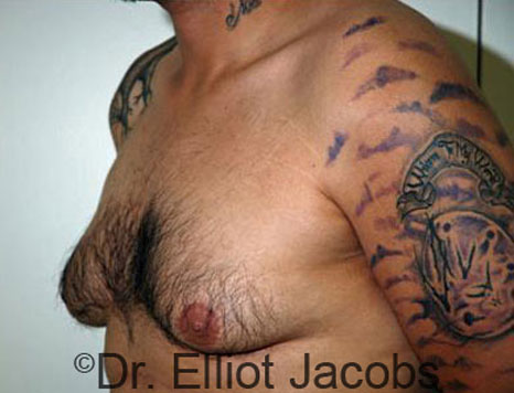 Male breast, before Gynecomastia treatment, l-side oblique view - patient 55
