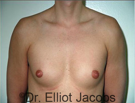 Male breast, before Gynecomastia treatment, front view, patient 56