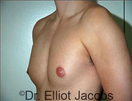 Male breast, before Gynecomastia treatment, l-side oblique view - patient 56