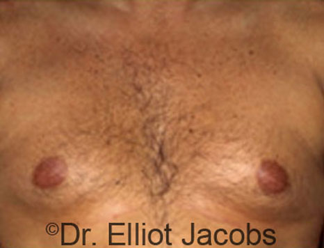 Male breast, before Gynecomastia treatment, front view, patient 57