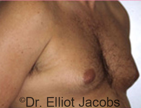 Male breast, before Gynecomastia treatment, l-side oblique view - patient 57
