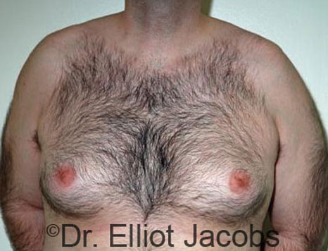 Male breast, before Gynecomastia treatment, front view, patient 58