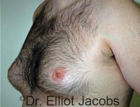 Male breast, before Gynecomastia treatment, l-side oblique view - patient 58