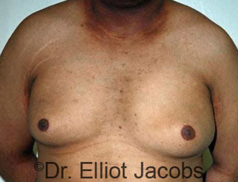 Male breast, before Gynecomastia treatment, front view, patient 59