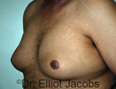 Male breast, before Gynecomastia treatment, l-side oblique view - patient 59