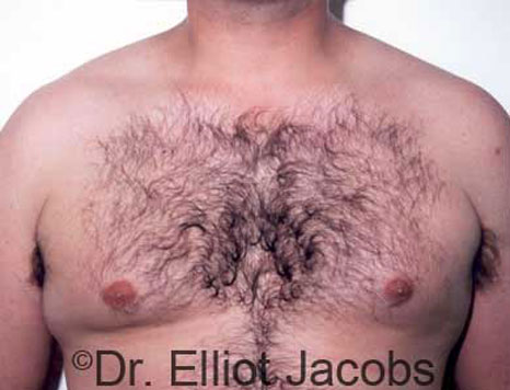 Male breast, before Gynecomastia treatment, front view, patient 6