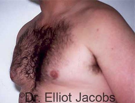 Male breast, before Gynecomastia treatment, l-side oblique view, patient 6