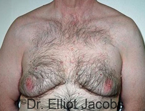 Male breast, before Gynecomastia treatment, front view, patient 60