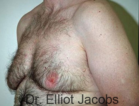 Male breast, before Gynecomastia treatment, l-side oblique view - patient 60