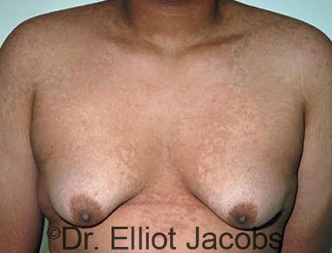 Male breast, before Gynecomastia treatment, front view, patient 61