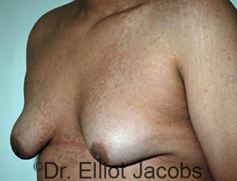 Male breast, before Gynecomastia treatment, l-side oblique view - patient 61