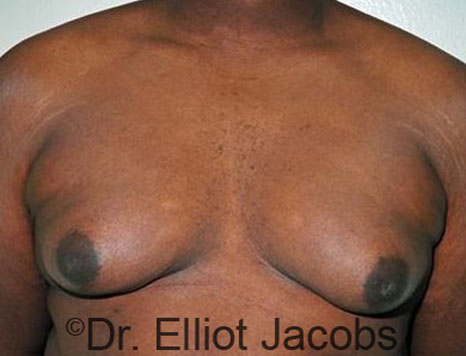 Male breast, before Gynecomastia treatment, front view, patient 62