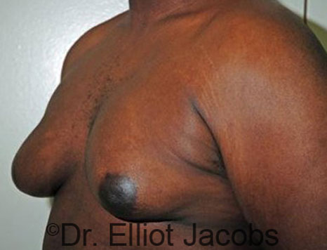 Male breast, before Gynecomastia treatment, l-side oblique view - patient 62