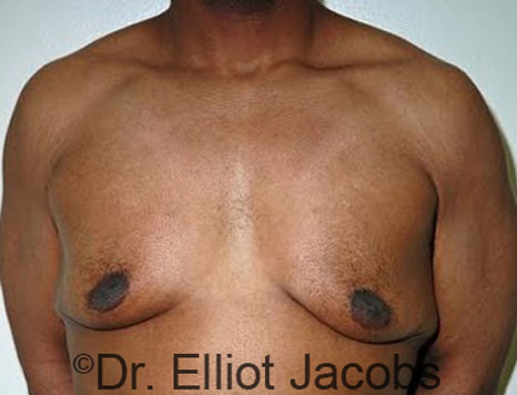 Male breast, before Gynecomastia treatment, front view, patient 63