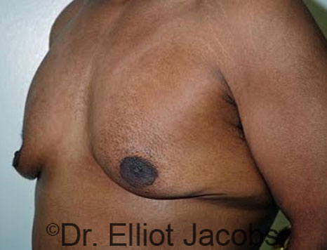 Male breast, before Gynecomastia treatment, l-side oblique view - patient 63
