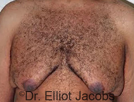 Male breast, before Gynecomastia treatment, front view, patient 64