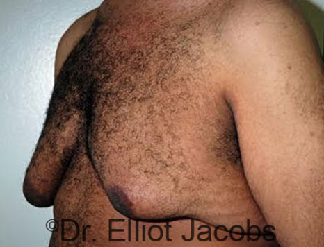 Male breast, before Gynecomastia treatment, l-side oblique view - patient 64