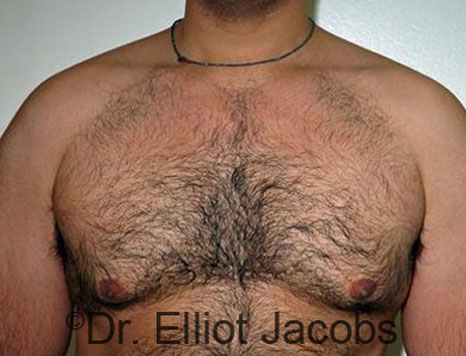 Male breast, before Gynecomastia treatment, front view, patient 65