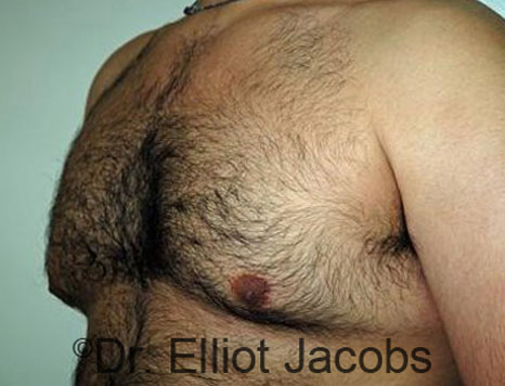 Male breast, before Gynecomastia treatment, l-side oblique view - patient 65