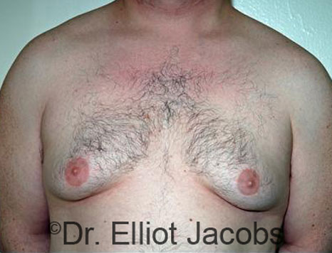 Male breast, before Gynecomastia treatment, front view, patient 66