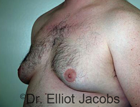 Male breast, before Gynecomastia treatment, l-side oblique view - patient 66