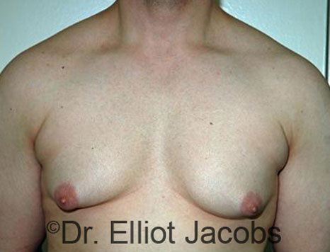 Male breast, before Gynecomastia treatment, front view, patient 67