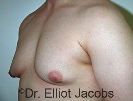 Male breast, before Gynecomastia treatment, l-side oblique view - patient 67