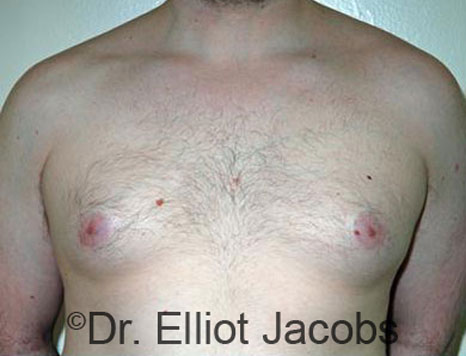 Male breast, before Gynecomastia treatment, front view, patient 68