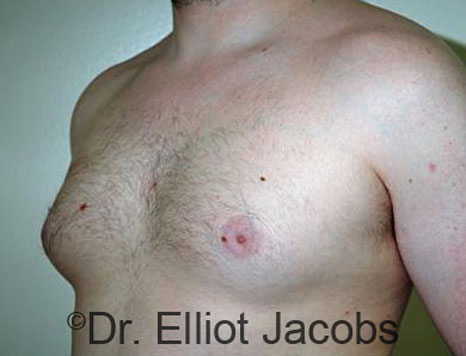 Male breast, before Gynecomastia treatment, l-side oblique view - patient 68
