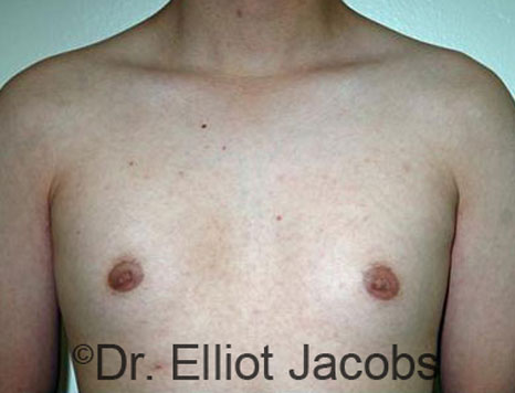 Male breast, before Gynecomastia treatment, front view, patient 69