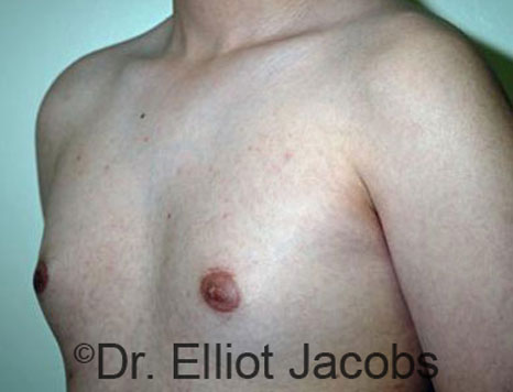 Male breast, before Gynecomastia treatment, l-side oblique view - patient 69