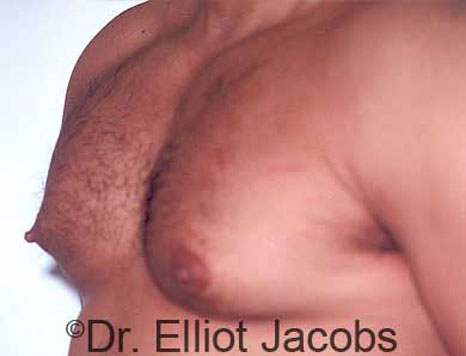 Male breast, before Gynecomastia treatment, l-side oblique view, patient 7