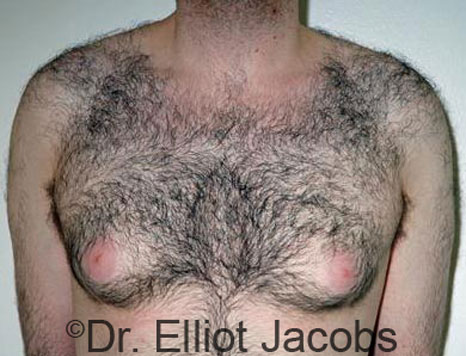 Male breast, before Gynecomastia treatment, front view, patient 70