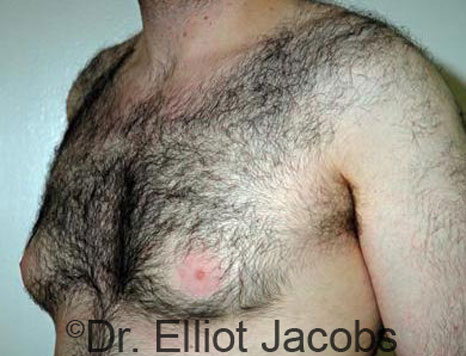 Male breast, before Gynecomastia treatment, l-side oblique view - patient 70