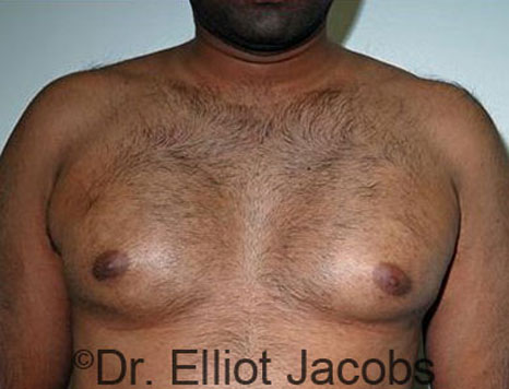 Male breast, before Gynecomastia treatment, front view, patient 71