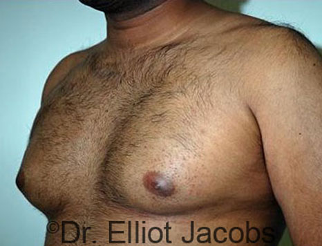 Male breast, before Gynecomastia treatment, l-side oblique view - patient 71